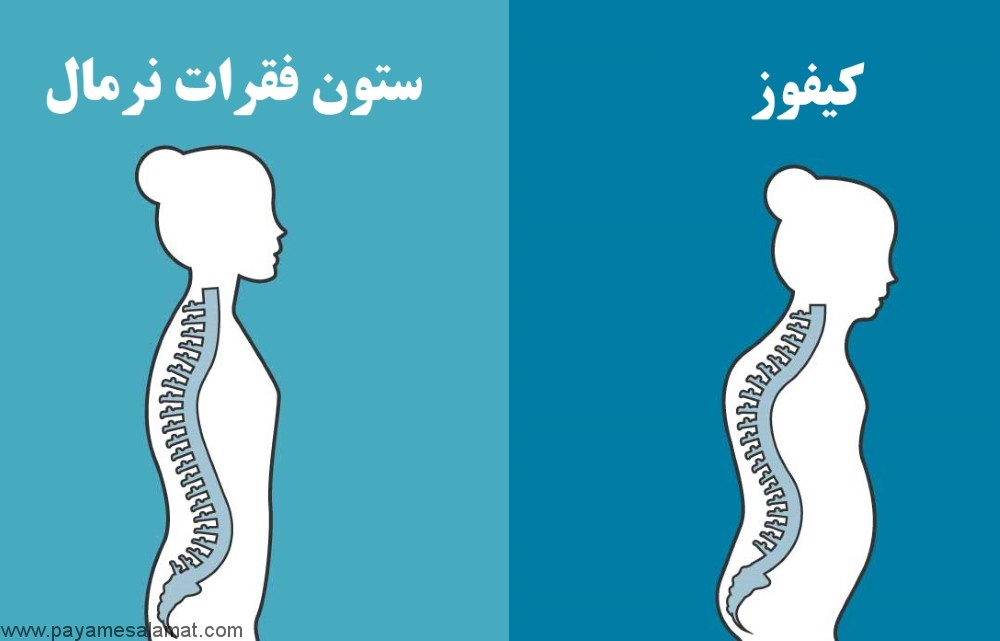 درمان کیفوز با ورزش گوژپشتی