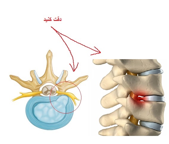 دیسک گردن